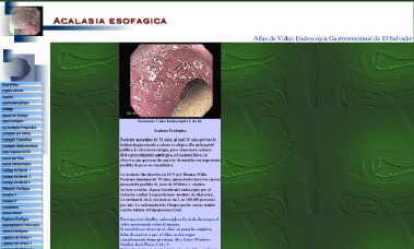 Acalasia del Esófago