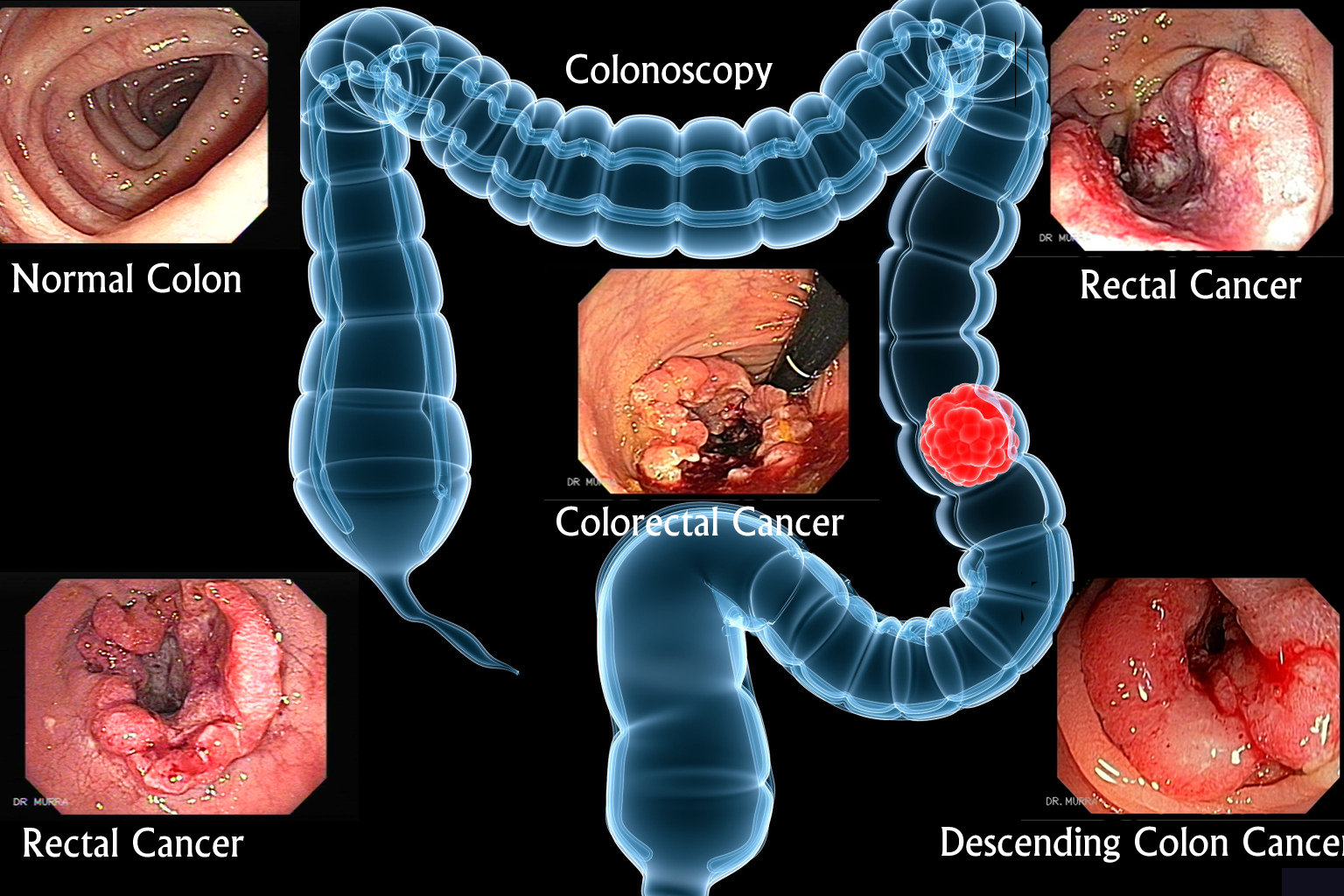 colon cancer 