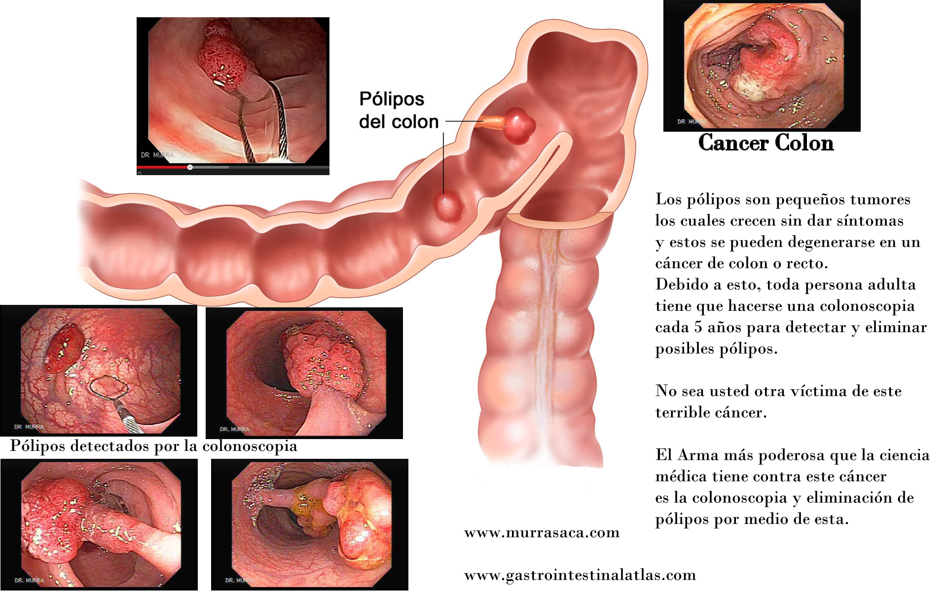 Tumor en el colon benigno