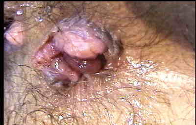 Hemorroides El Salvador