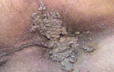 Hemorroides El Salvador