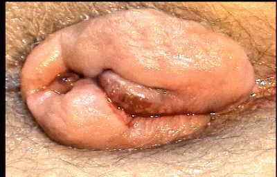 Hemorroides El Salvador