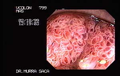 What are precancerous colon polyps?