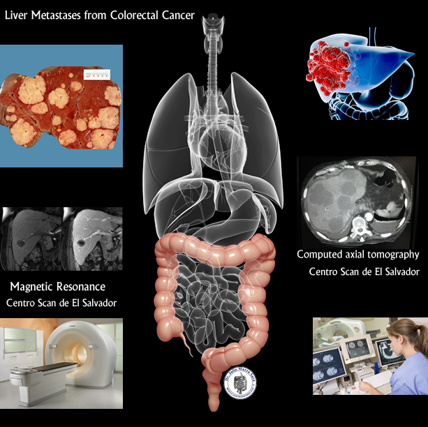 liver metastases from colorectal cancer