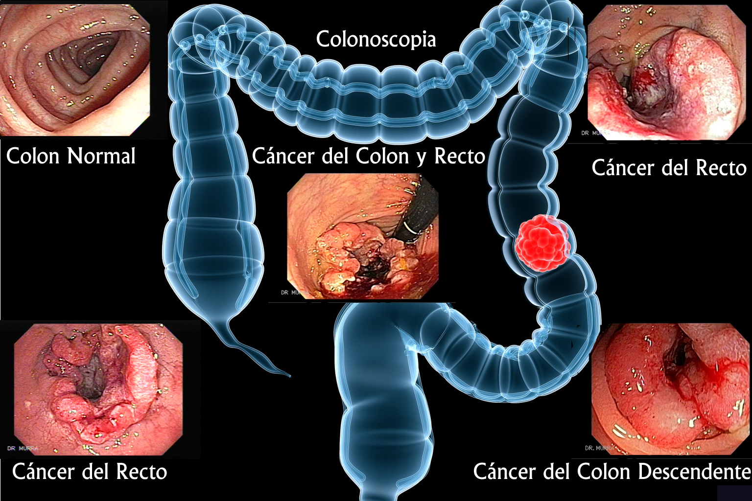 cancer de colon que organos afecta viermi subcutanati